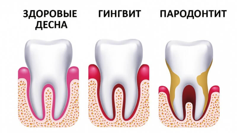 Мифы о стоматологии. Чем опасен пародонтит?