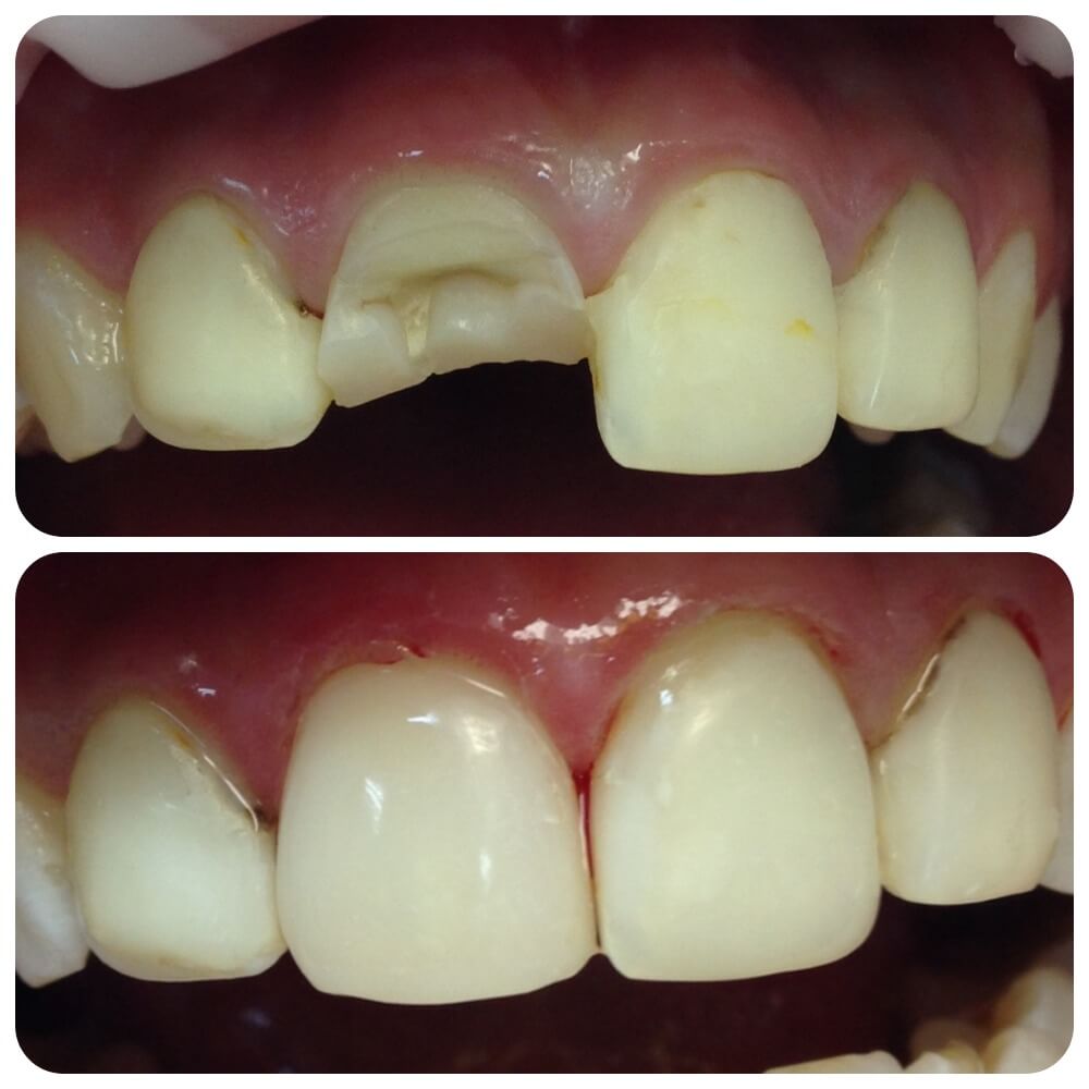 Восстановление зуба после травмы материалом Estelite Asteria.