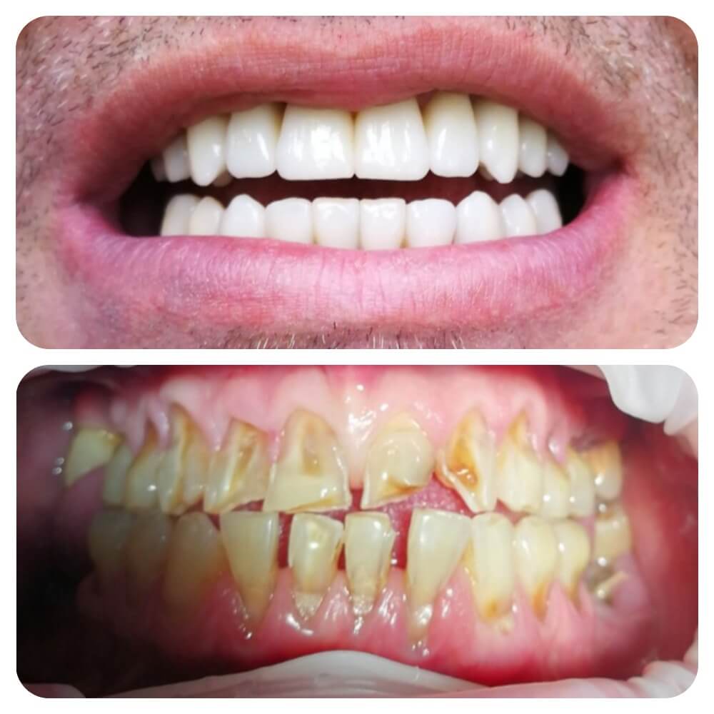 Восстановление фронтальной группы зубов