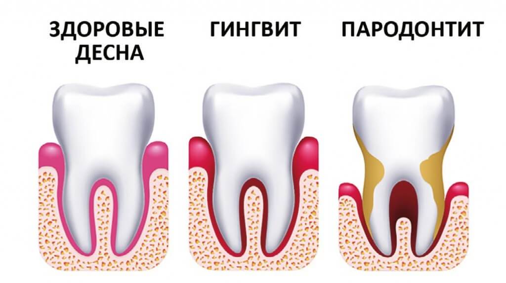 Лечение пародонтоза Томск Мира частная стоматология томск