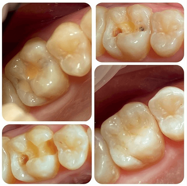 лечение среднего кариеса 26 зуба