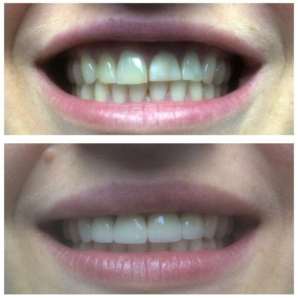 Восстановление 12,11,21,22 зубов с помощью ультратонких виниров из прессованной керамики Emax. 