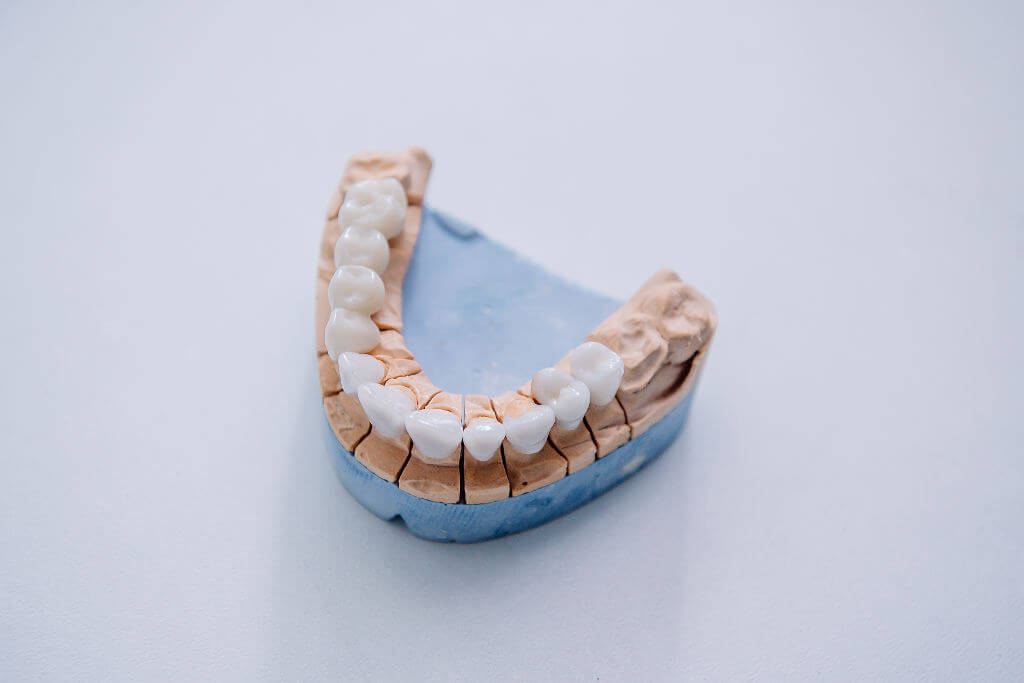Безметалловое протезирование зубов