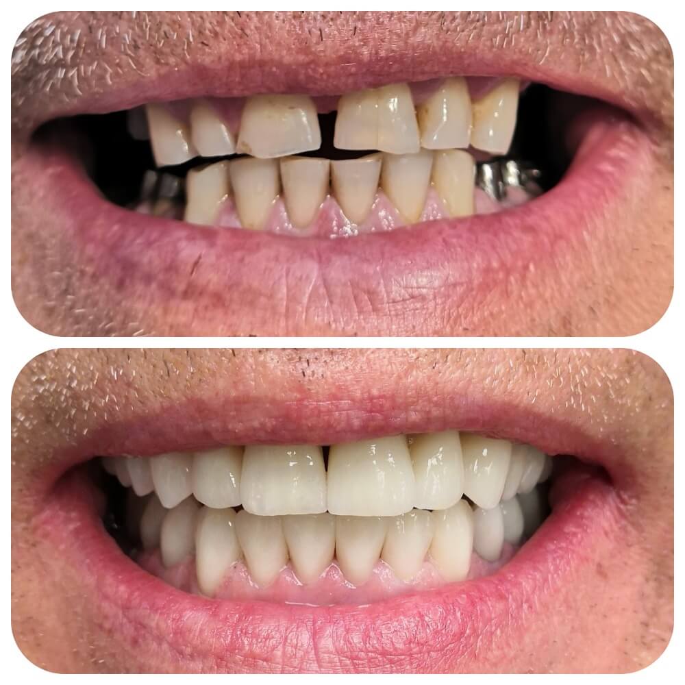 Тотальное восстановление жевательной эффективности и эстетики зубов: